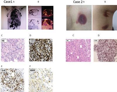 A novel germline HAVCR2 (TIM-3) compound heterozygous mutation is related to hemophagocytic lymphohistiocytic syndrome in EBV-positive peripheral T-cell lymphoma (NOS) with down-regulated TIM-3 signaling